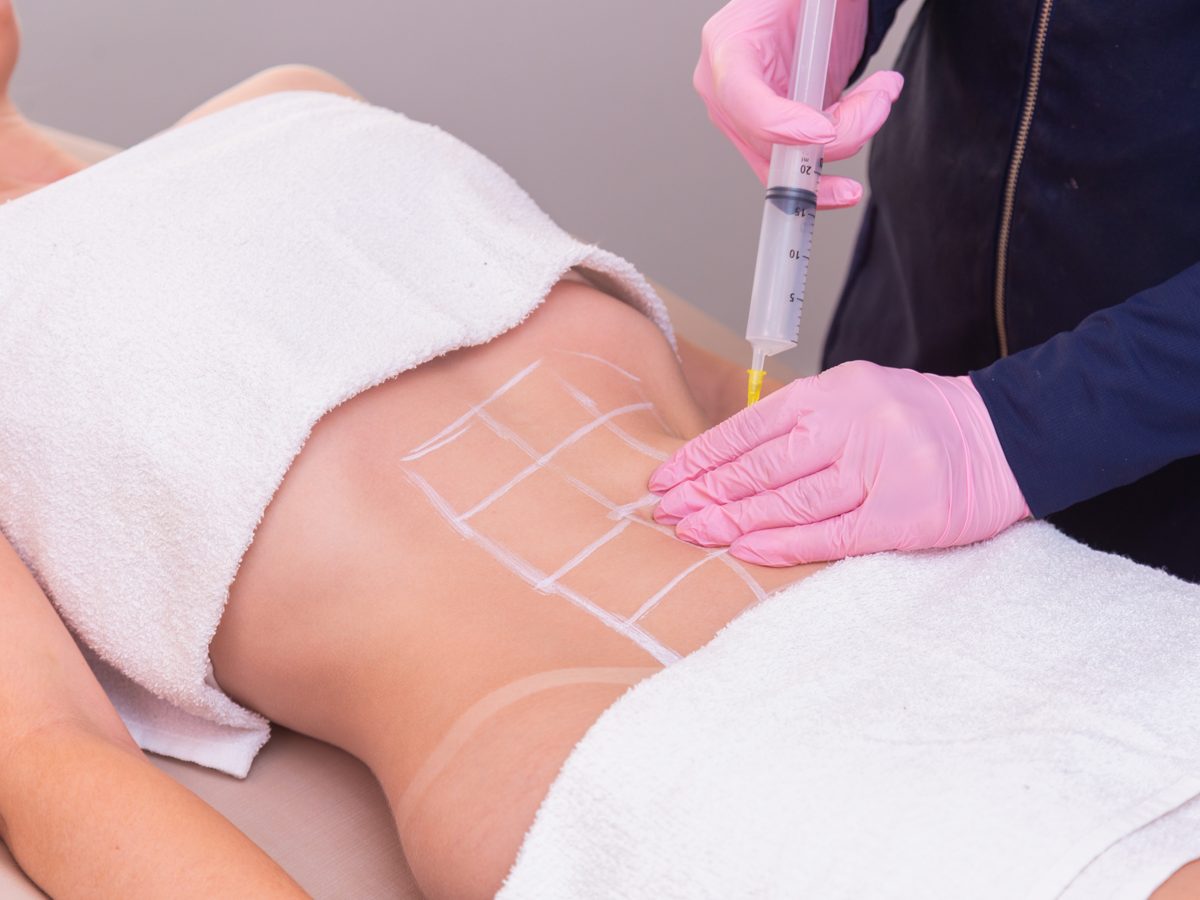 Procedimento de enxerto de gordura com marcação em consultório médico