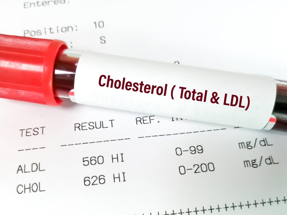 Tubo de exame de sangue com laudo de colesterol total e LDL